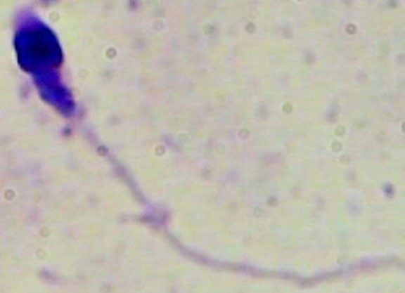 Abnormal sperm head shape and cytoplasmic droplets