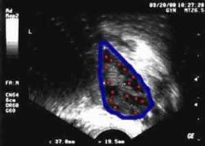 High ovarian volume and high antral follicle counts