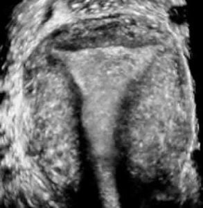 normal uterus in the coronal plane