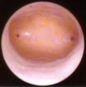 normal uterine cavity hysteroscopy picture
