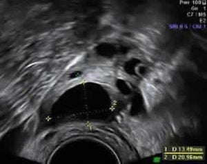 Single mature follicle in ovary ultrasound picture