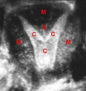 uterine septum on a coronal plane