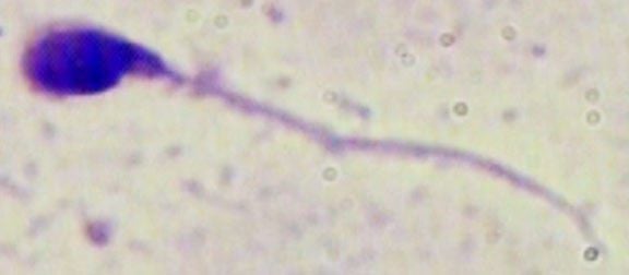 Sperm with abnormally short tail