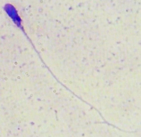 Tapered head sperm abnormality