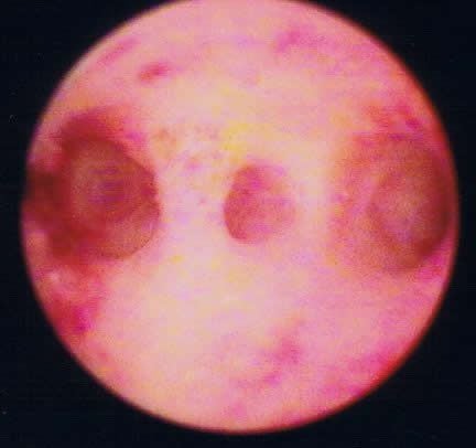 uterine scar tissue hysteroscopy picture