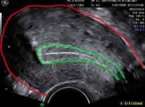 Ultrasound picture with uterus and lining outlined