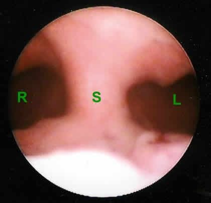uterine septum on hysteroscopy